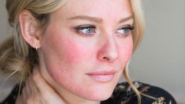 Detail Bedak Untuk Rosacea Nomer 10