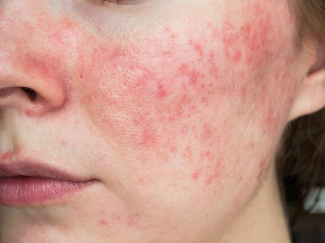 Detail Bedak Untuk Rosacea Nomer 13