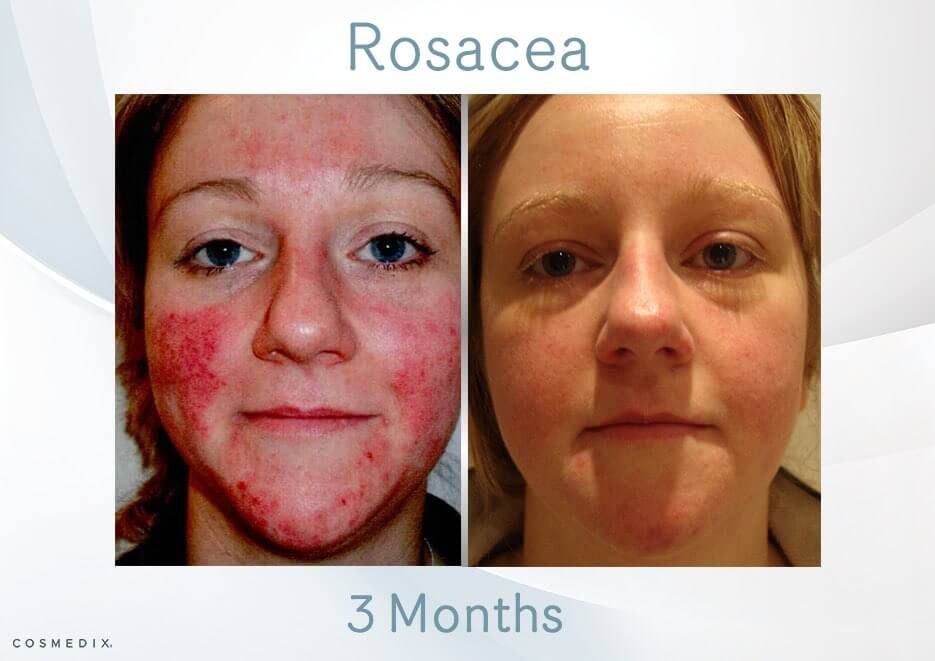 Detail Bedak Untuk Rosacea Nomer 4