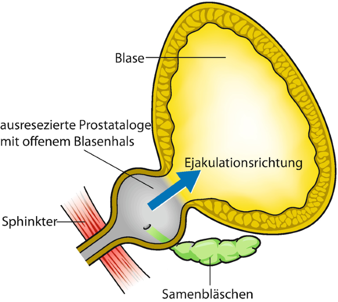 Detail Blasenkrankheiten Bei Frauen Nomer 4