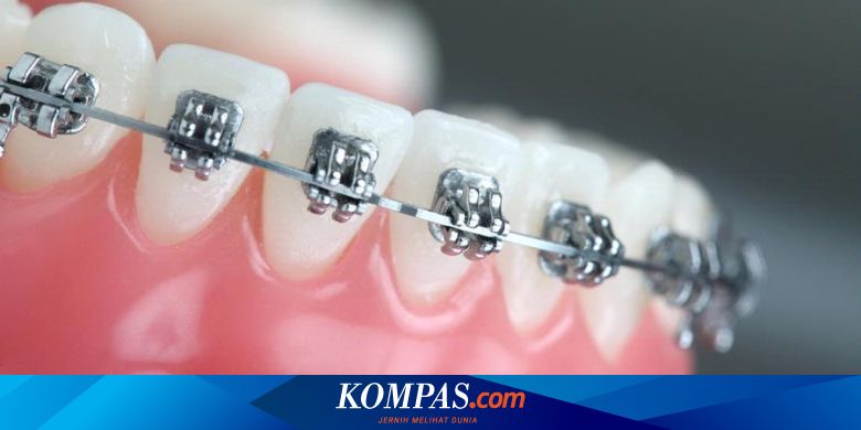 Detail Cara Buka Behel Sendiri Di Rumah Nomer 45