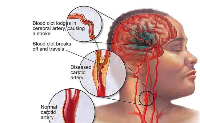 Detail Cara Terapi Stroke Sebelah Kanan Di Rumah Nomer 27