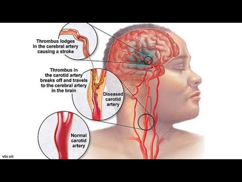 Detail Cara Terapi Stroke Sebelah Kanan Di Rumah Nomer 5