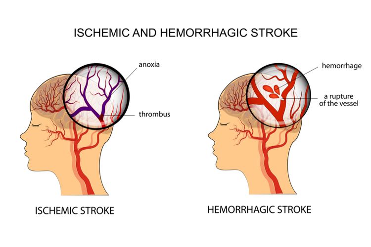 Detail Cara Terapi Stroke Sebelah Kanan Di Rumah Nomer 50