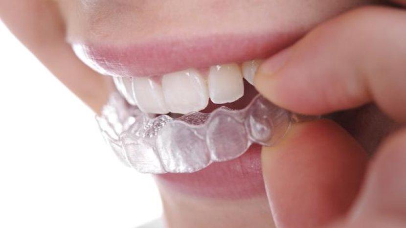 Detail Clear Aligner Harga Nomer 18