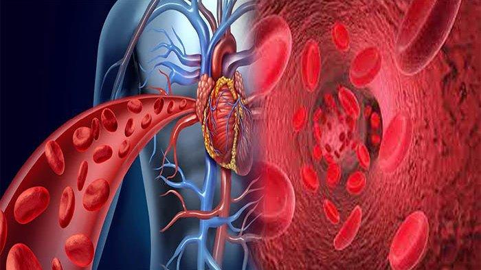 Detail Contoh Penyakit Yang Dapat Mengganggu Organ Peredaran Darah Nomer 24