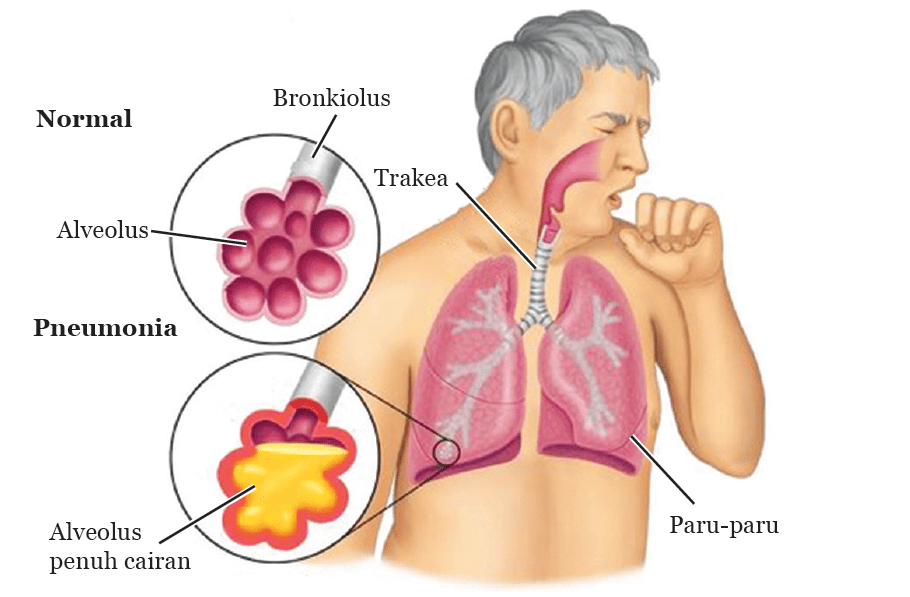 Detail Gambar Alveolus Manusia Nomer 47