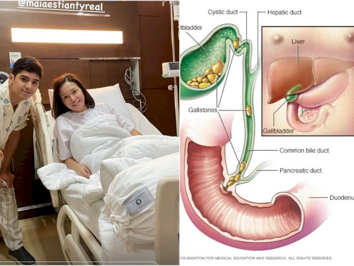 Detail Gambar Batu Empedu Manusia Nomer 37