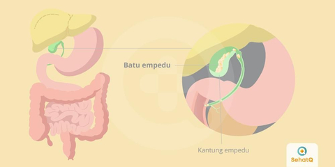 Detail Gambar Batu Empedu Manusia Nomer 42