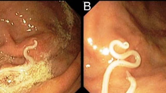 Detail Gambar Cacing Dalam Perut Manusia Nomer 9