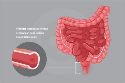 Detail Gambar Dan Penjelasan Orkitis Nomer 9