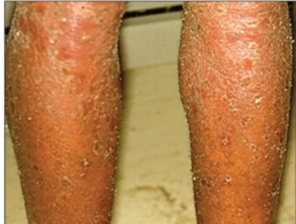 Detail Gambar Dermatitis Generalisata Nomer 11