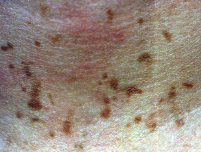Detail Gambar Dermatitis Generalisata Nomer 18