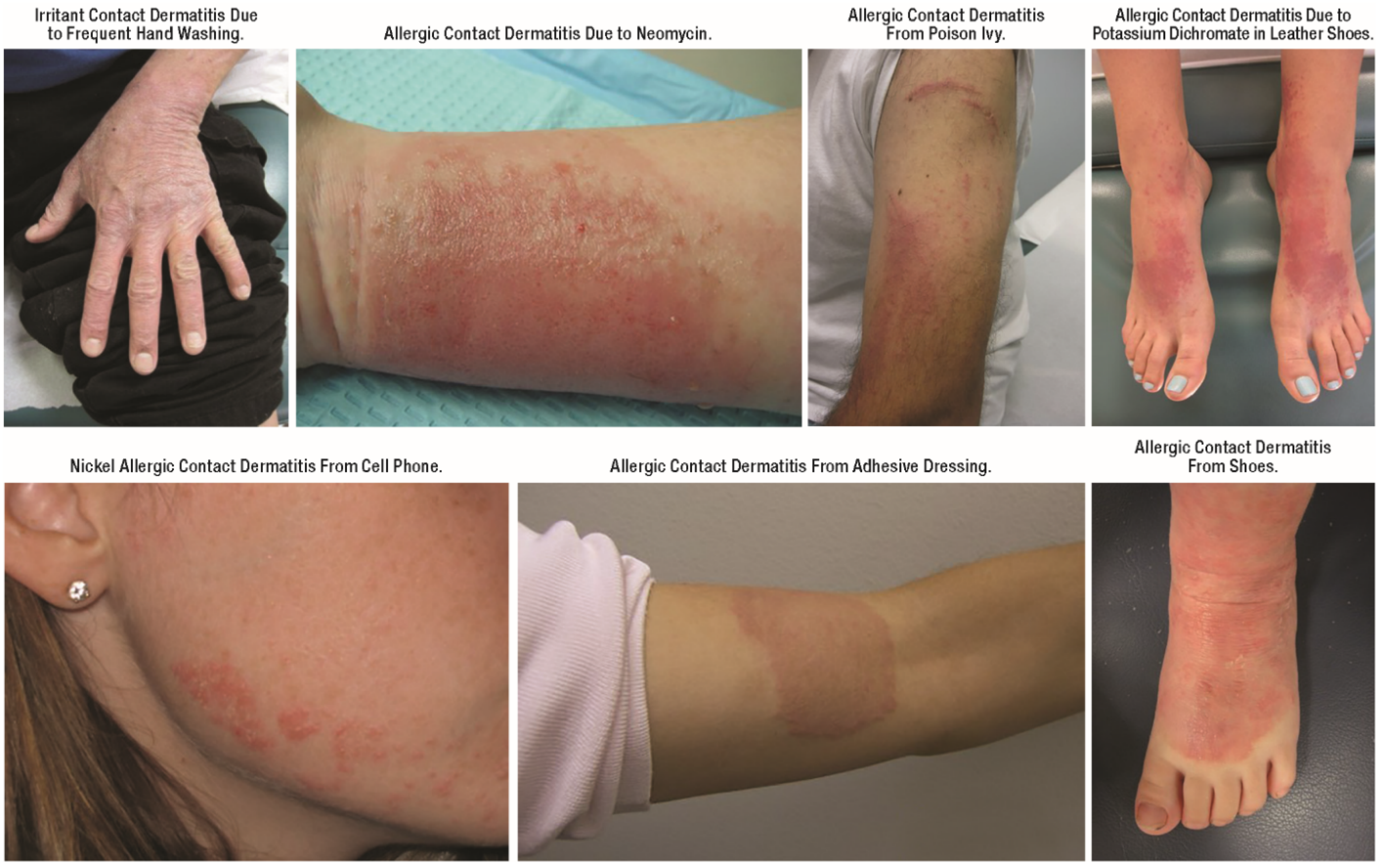 Detail Gambar Dermatitis Generalisata Nomer 23