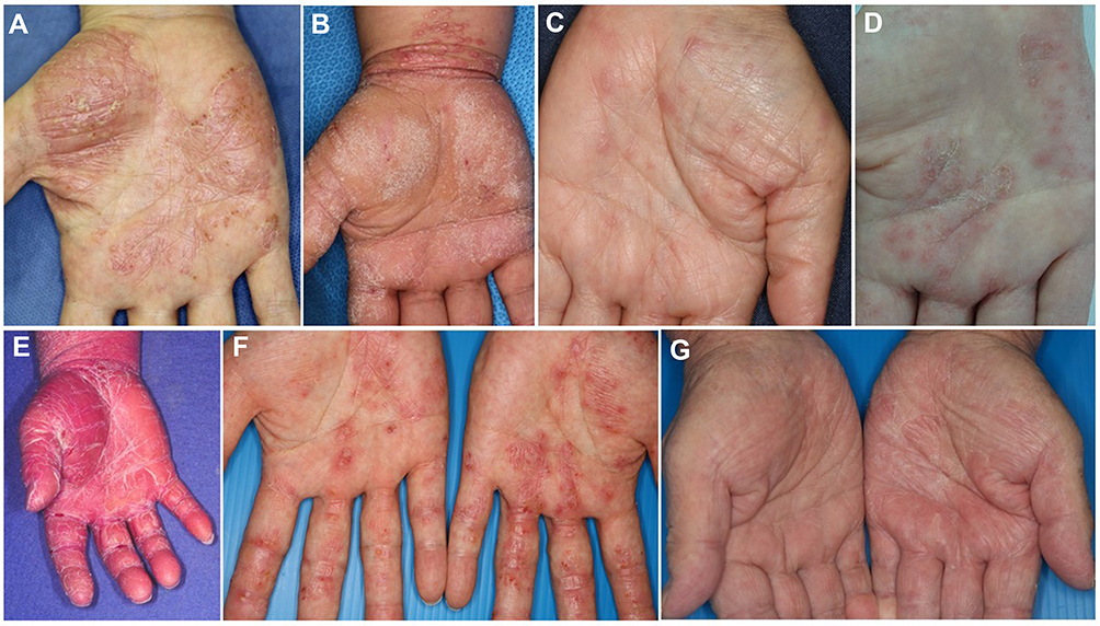 Detail Gambar Dermatitis Generalisata Nomer 24