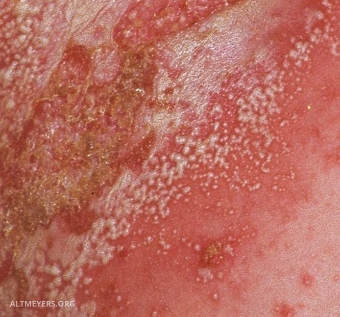 Detail Gambar Dermatitis Generalisata Nomer 28