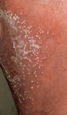 Detail Gambar Dermatitis Generalisata Nomer 29