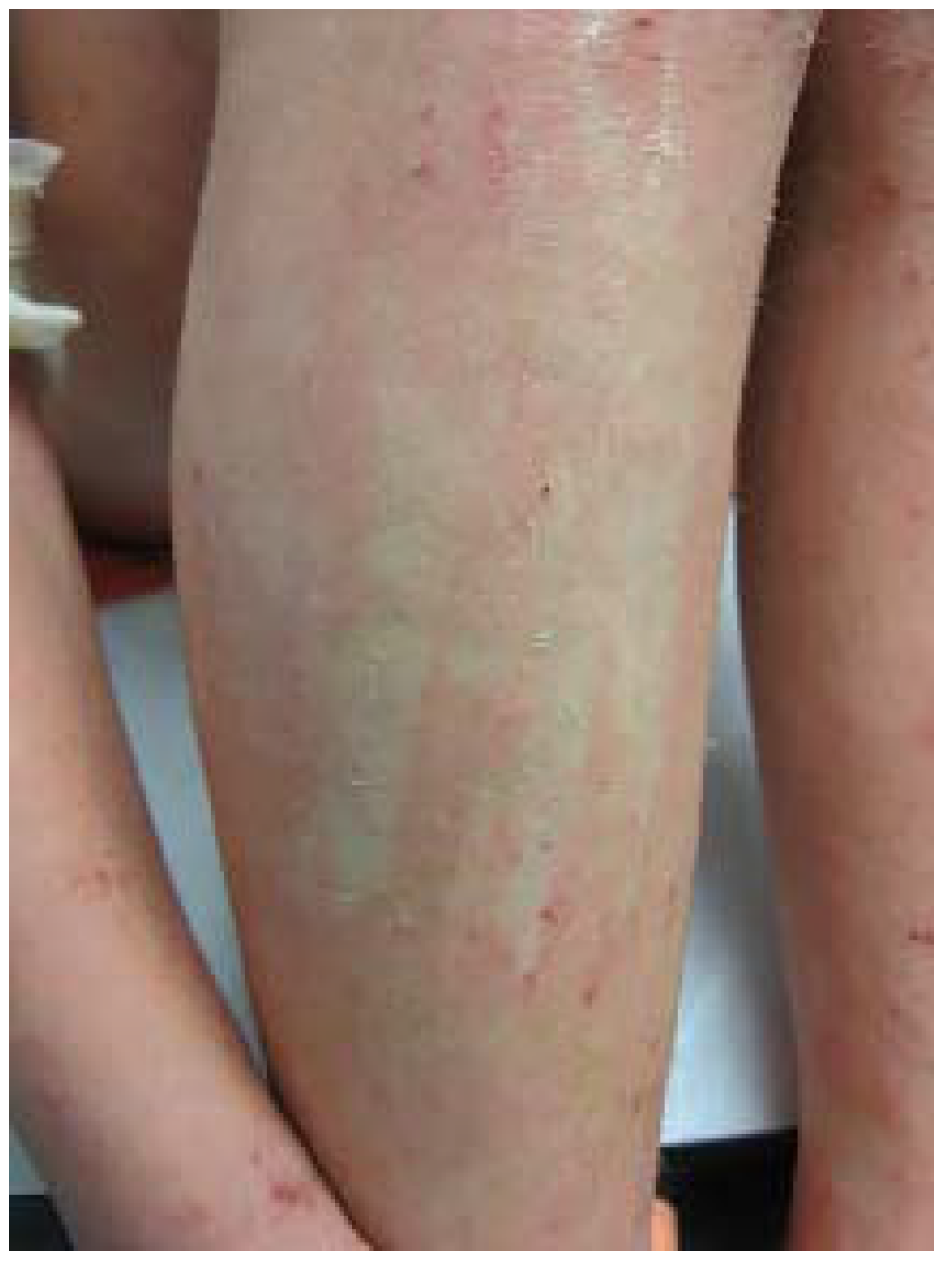 Detail Gambar Dermatitis Generalisata Nomer 38