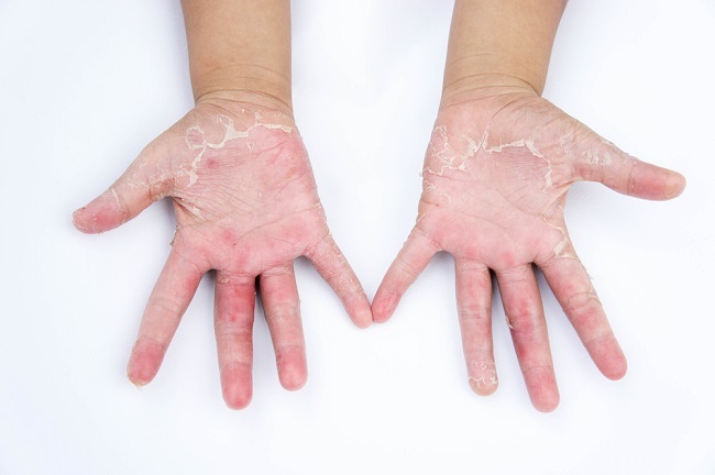 Gambar Dermatitis Kontak Alergi - KibrisPDR