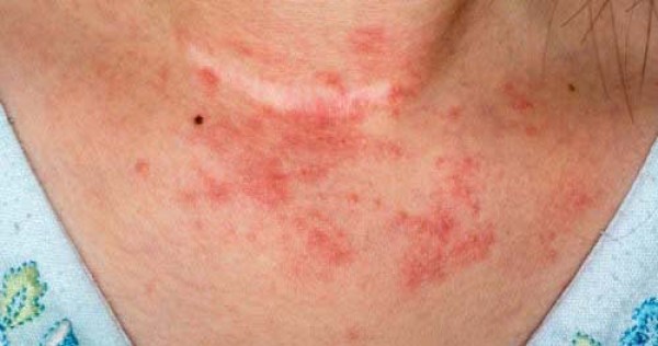 Detail Gambar Dermatitis Kontak Alergi Nomer 11