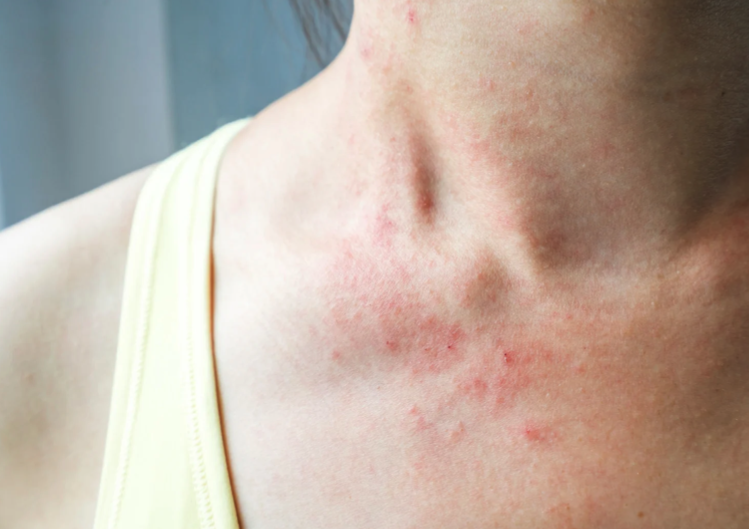 Detail Gambar Dermatitis Kontak Alergi Nomer 17