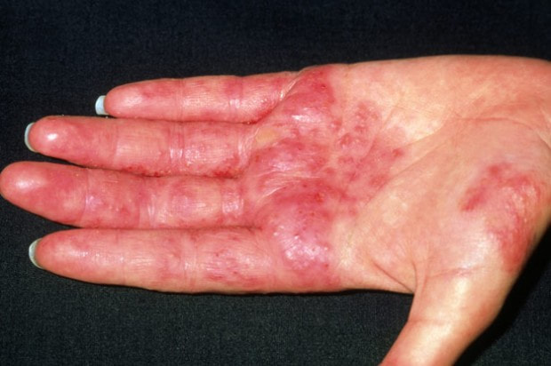 Detail Gambar Dermatitis Kontak Alergi Nomer 21