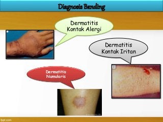 Detail Gambar Dermatitis Kontak Alergi Nomer 25