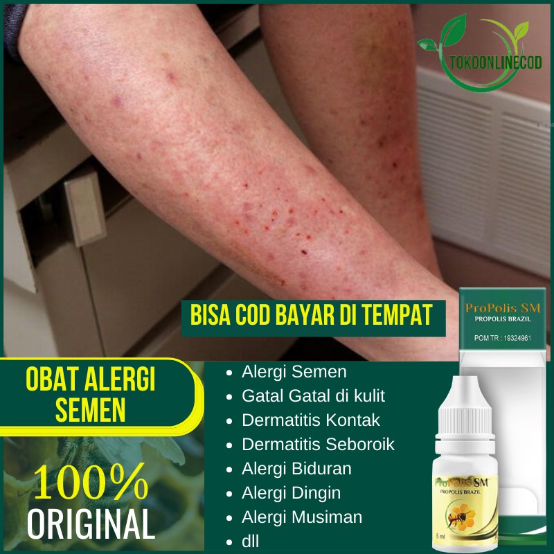 Detail Gambar Dermatitis Kontak Alergi Nomer 30