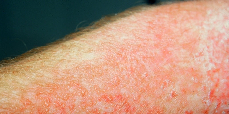 Detail Gambar Dermatitis Kontak Alergi Nomer 39