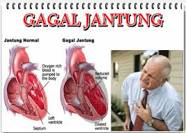 Detail Gambar Gagal Jantung Nomer 17