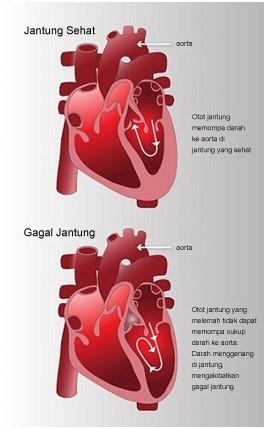 Detail Gambar Gagal Jantung Nomer 19