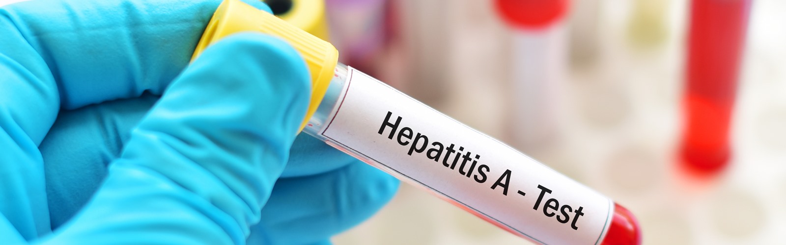 Detail Gambar Hepatitis A Nomer 44