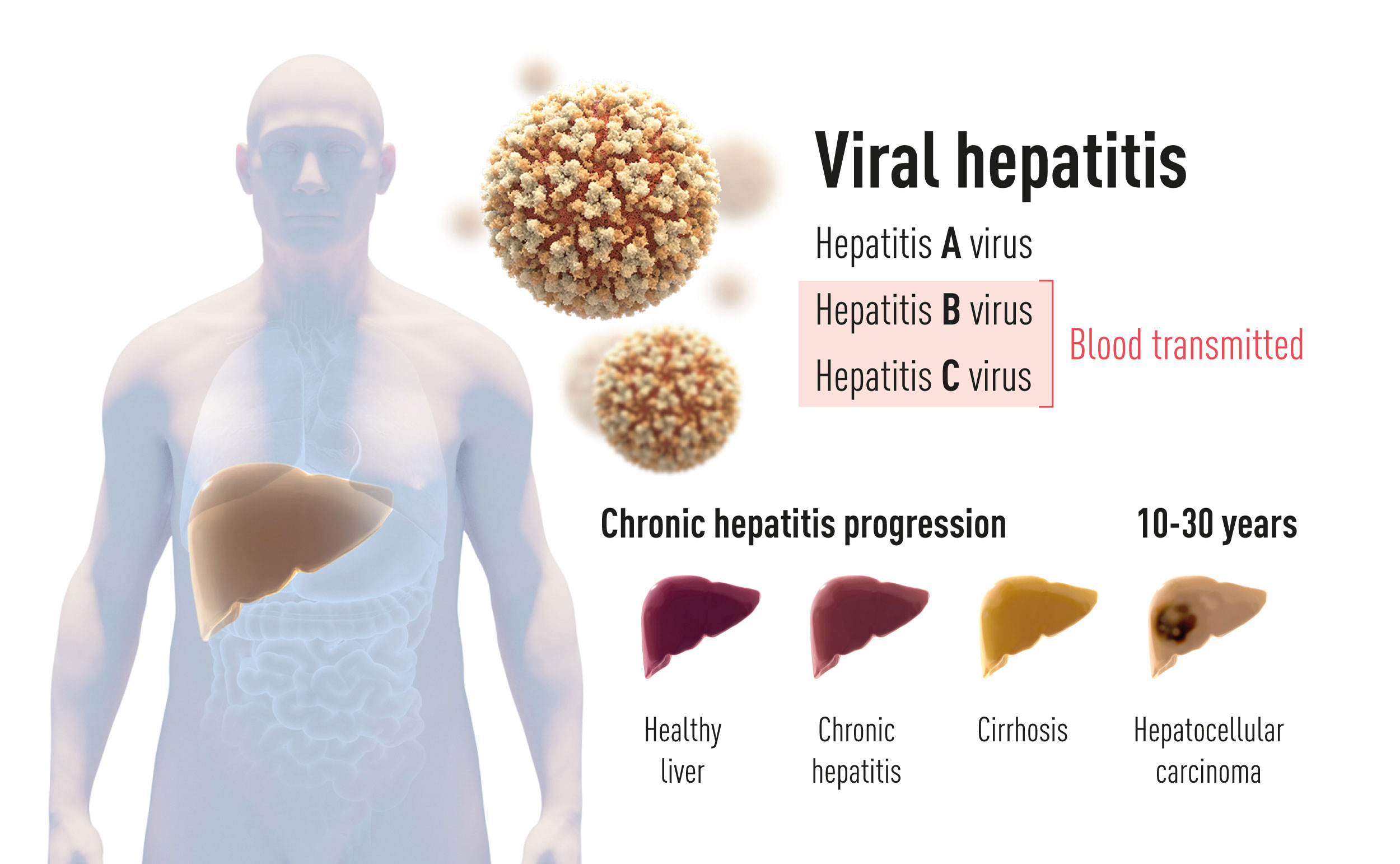 Detail Gambar Hepatitis A Nomer 49