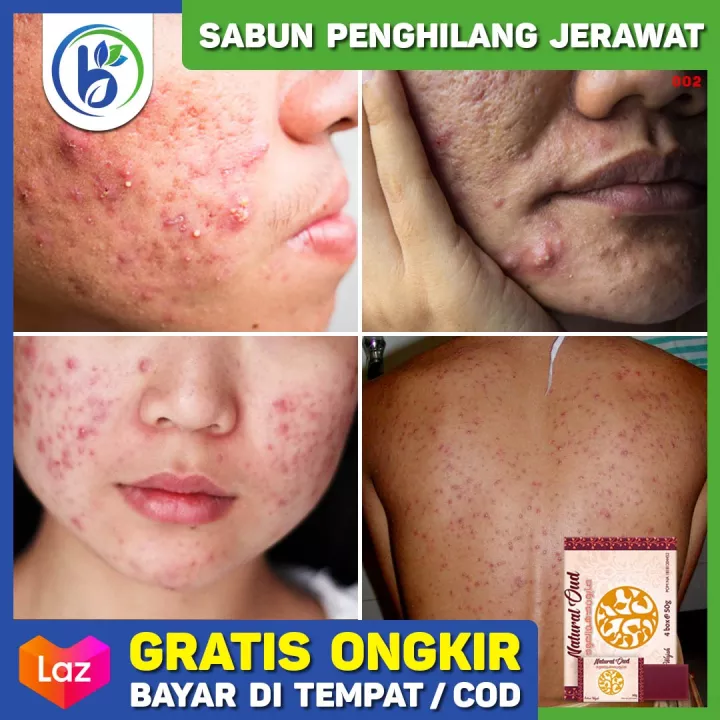 Detail Gambar Jerawat Papula Nomer 29