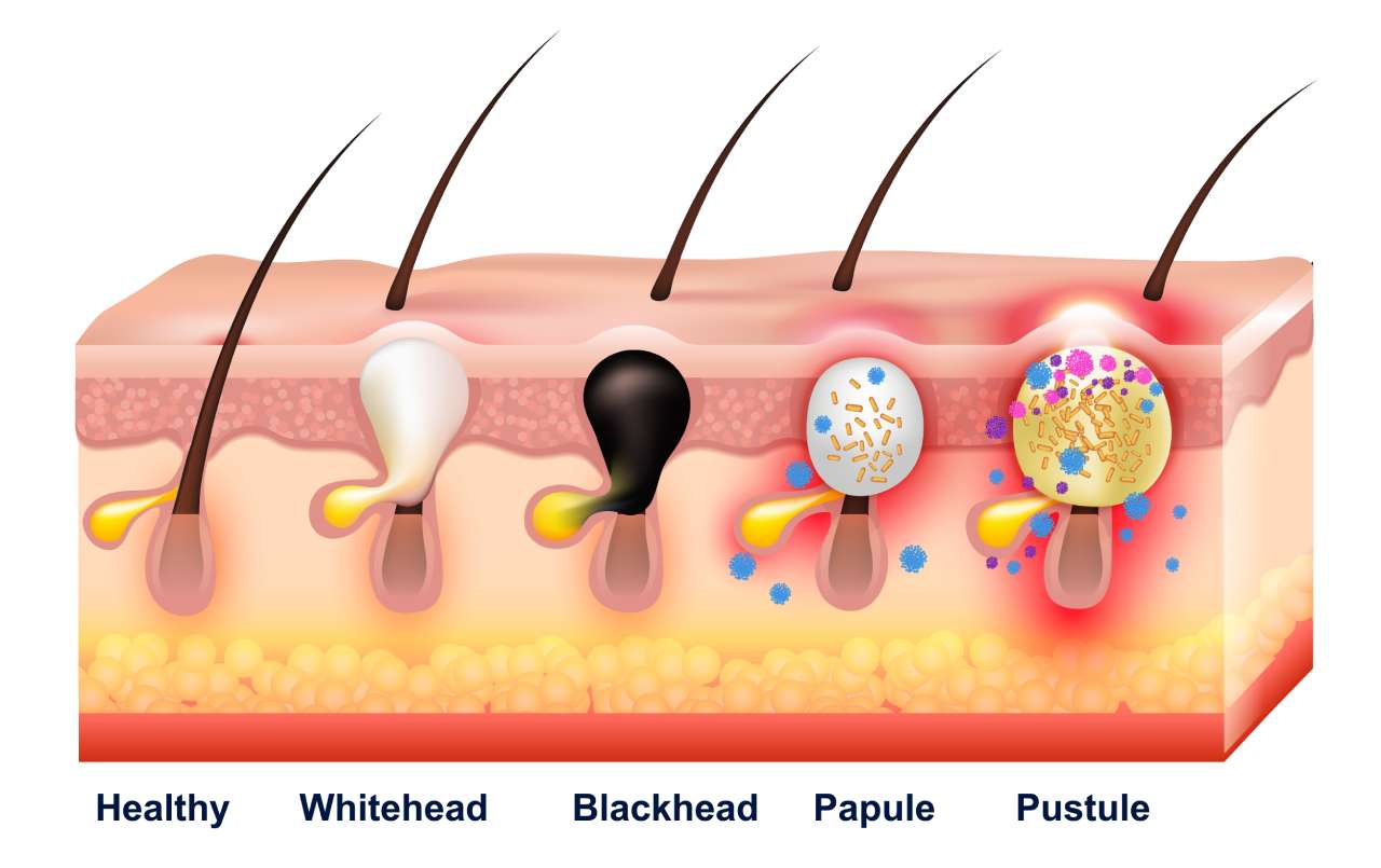 Detail Gambar Jerawat Papula Nomer 31