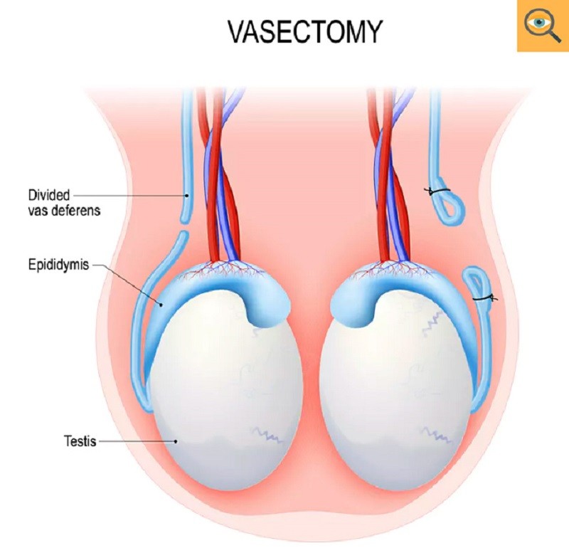 Gambar Kb Vasektomi - KibrisPDR