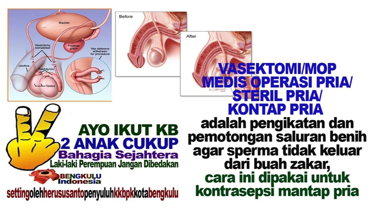 Detail Gambar Kb Vasektomi Nomer 15