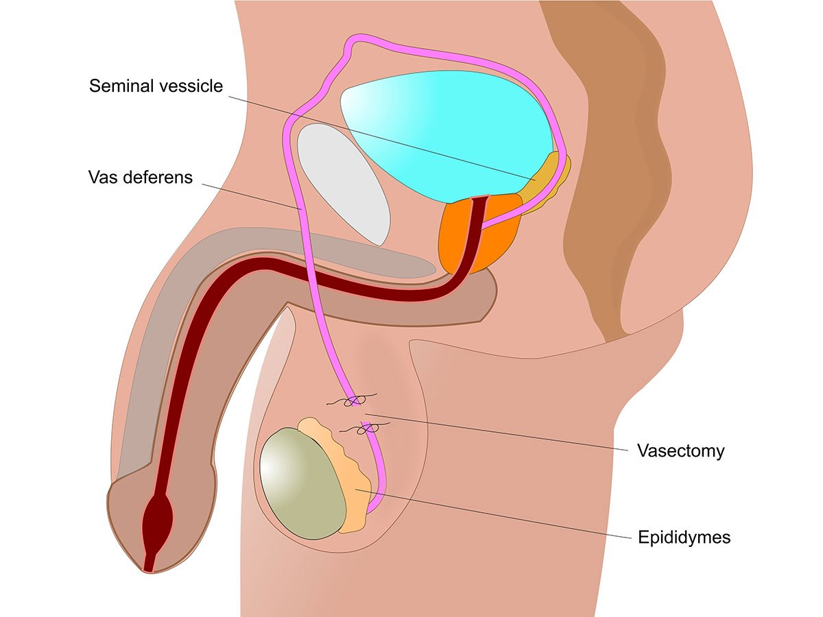 Detail Gambar Kb Vasektomi Nomer 31