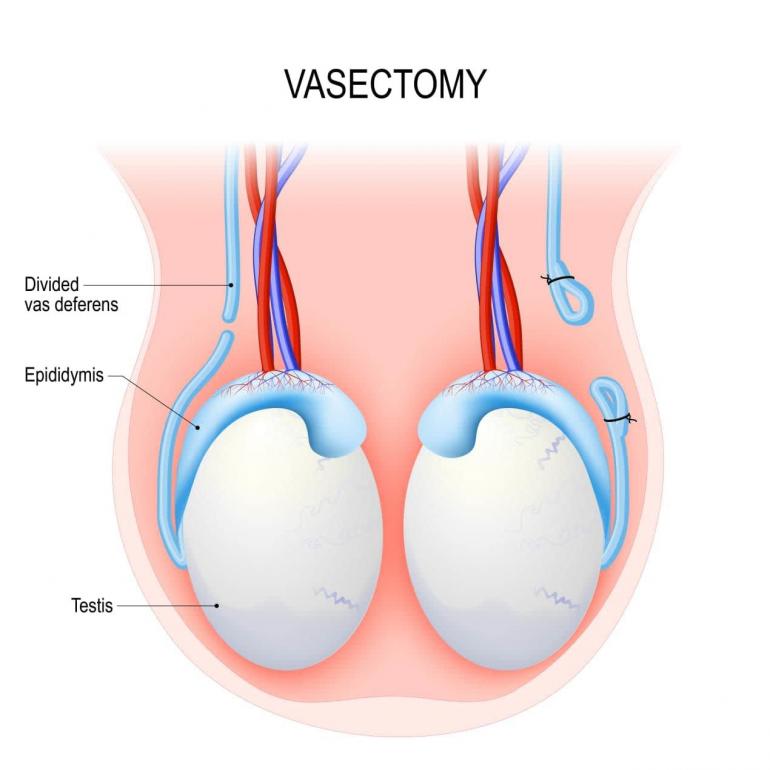 Detail Gambar Kb Vasektomi Nomer 32