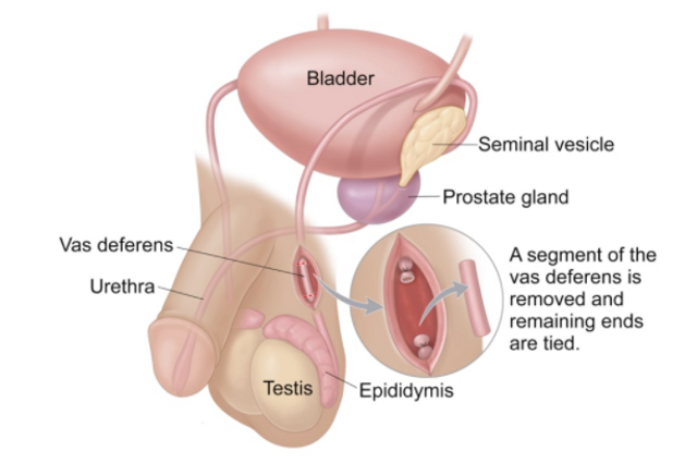 Detail Gambar Kb Vasektomi Nomer 7