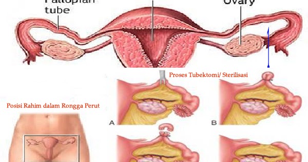 Detail Gambar Kb Vasektomi Dan Tubektomi Png Nomer 7