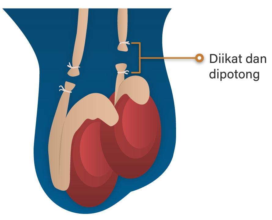 Detail Gambar Kb Vasektomi Png Nomer 7