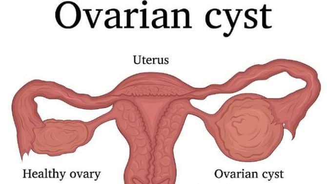 Detail Gambar Ovarium Dan Fungsinya Nomer 19