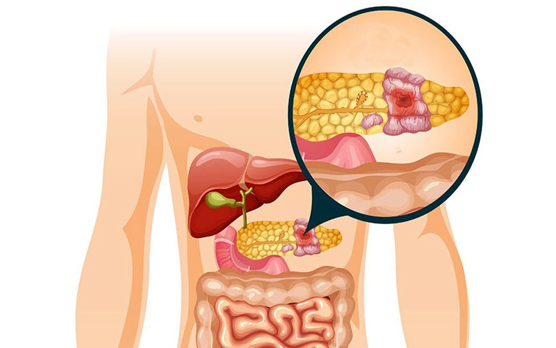 Detail Gambar Pankreas Manusia Nomer 3