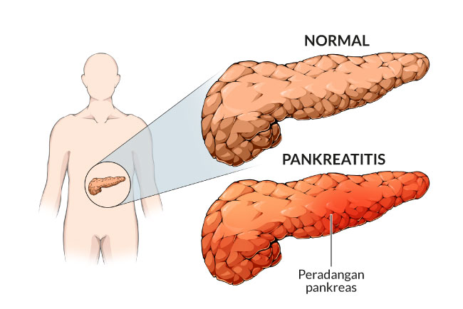 Detail Gambar Pankreas Manusia Nomer 10