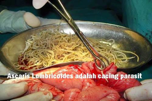 Detail Gambar Penyakit Ascariasis Nomer 15