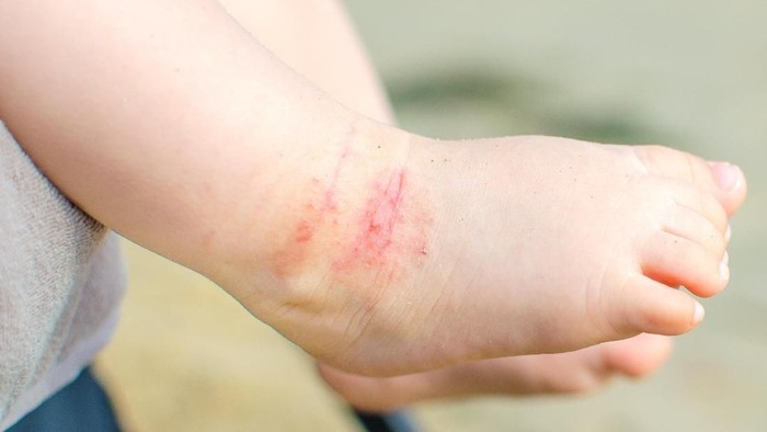 Detail Gambar Penyakit Dermatitis Atopik Nomer 11