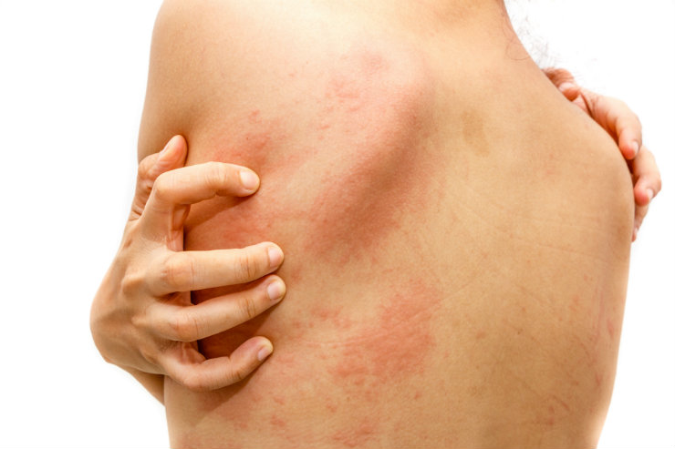 Download Gambar Penyakit Dermatitis Atopik Nomer 16