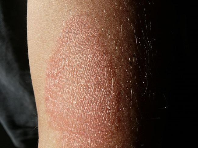 Detail Gambar Penyakit Dermatitis Atopik Nomer 18