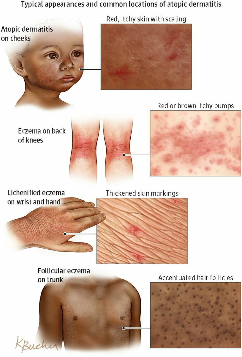 Detail Gambar Penyakit Dermatitis Atopik Nomer 24